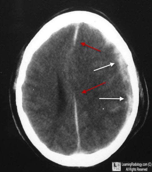 Subdural Hematoma